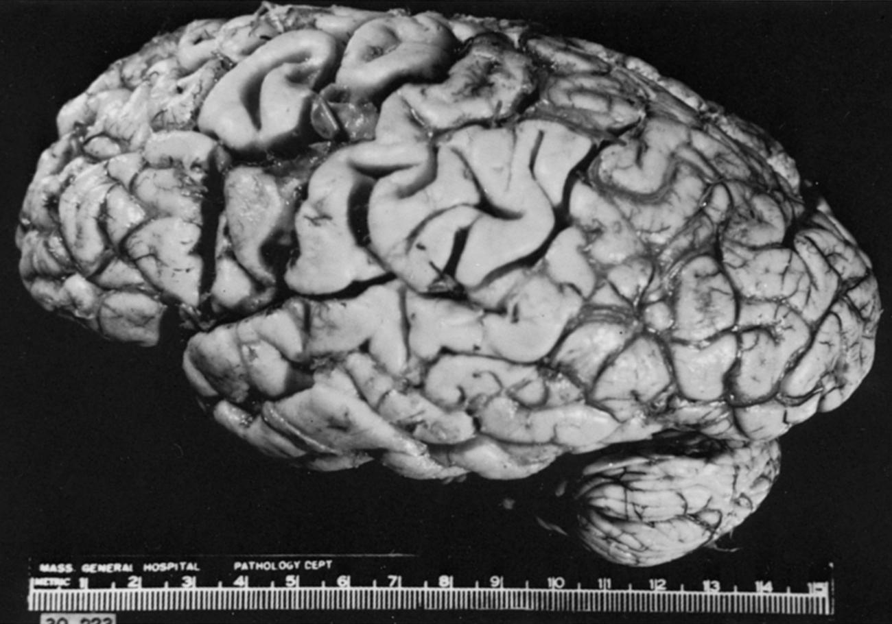 Fig. 24.10, Small upper rolandic infarction. The pia-arachnoid has been stripped away to show the infarct.