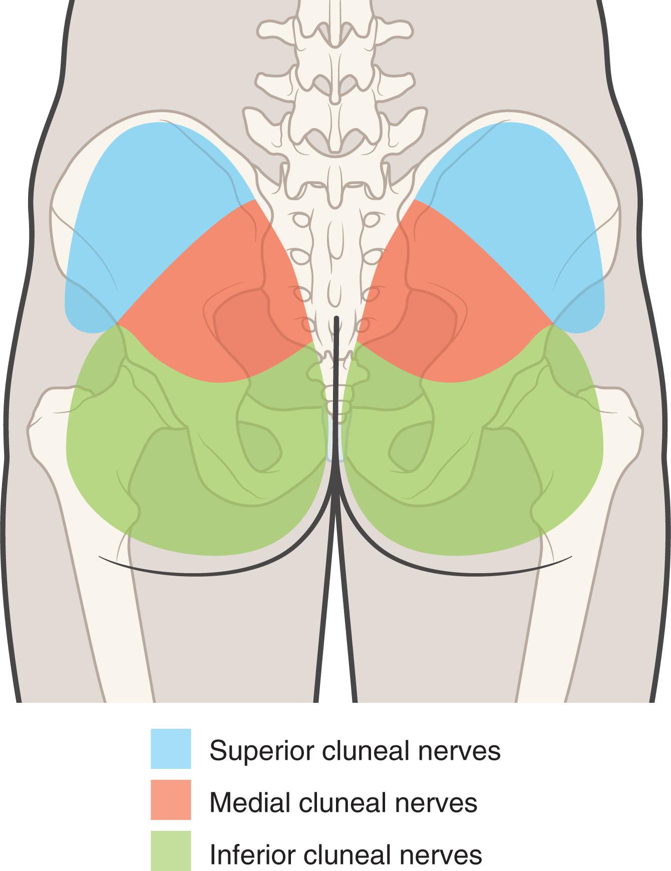 Figure 20.1, Pattern of pain from the cluneal nerves––superior, middle, and inferior.