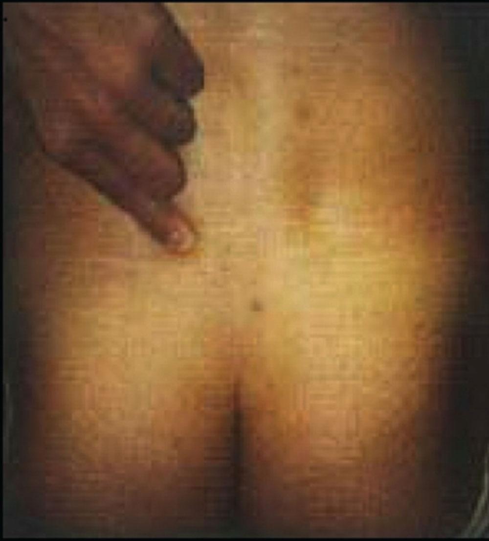 Figure 20.2, Location of tenderness from sacroiliac joint (“Fortin finger test”).