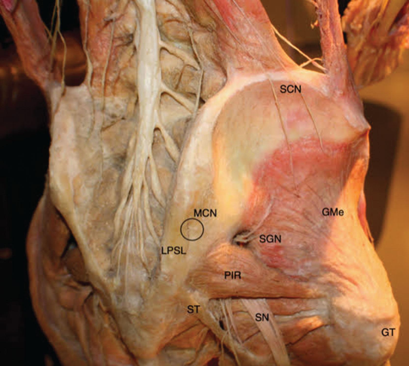 Figure 20.3, Dissection of the buttocks. GMe , Gluteus medius muscle; GT , greater trochanter; LPSL , long posterior sacral ligament; MCN , middle cluneal nerve (circled); PIR , piriformis muscle; SCN , superior cluneal nerve; SGN , superior gluteal nerve; SN , sciatic nerve; ST , sacrotuberous ligament.