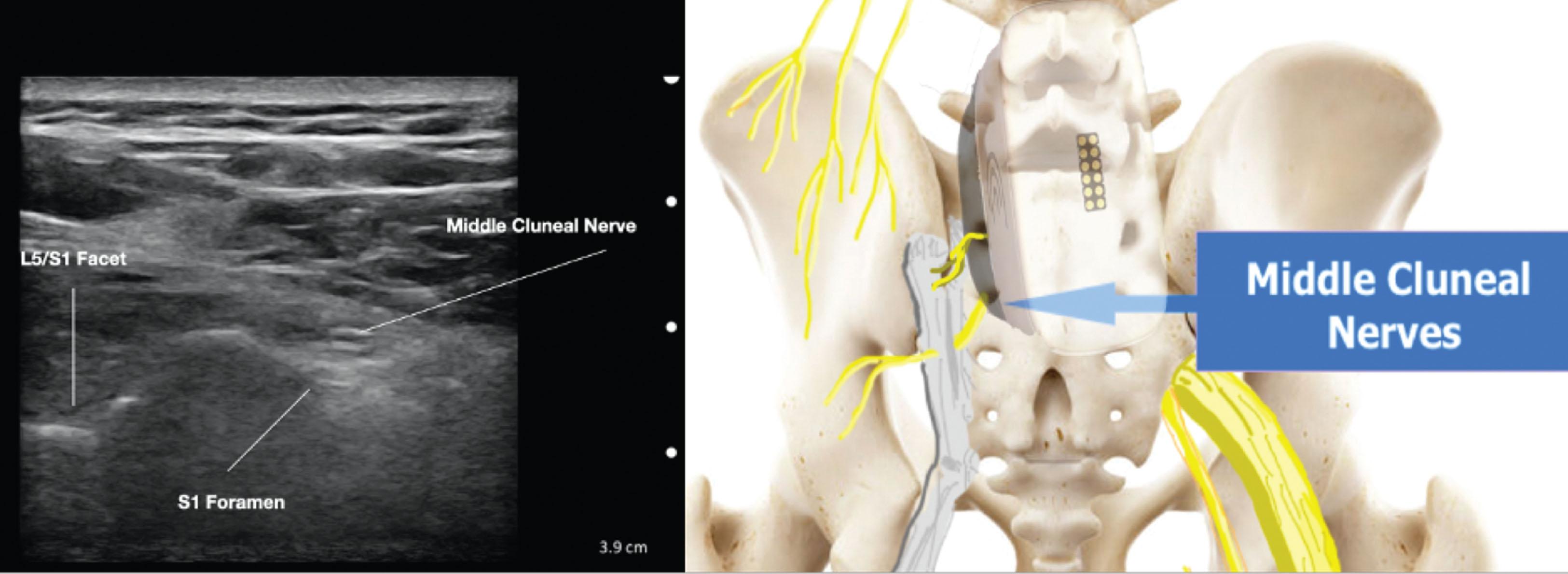 Figure 20.5, Ultrasound image of the middle cluneal nerve at S1, with skeleton for reference. Blue box on the skeleton represents the ultrasound probe orientation.