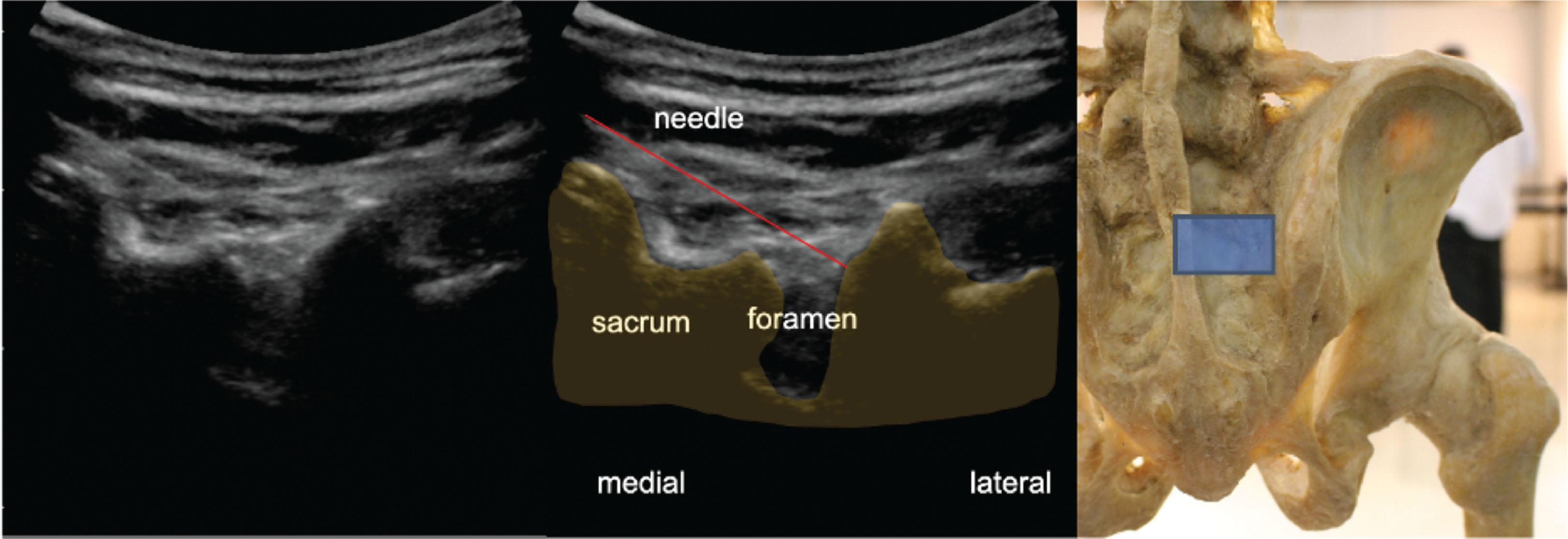 Figure 20.7, Ultrasound image of the middle cluneal nerve, with skeleton for reference. Blue box on the skeleton represents the ultrasound probe orientation.