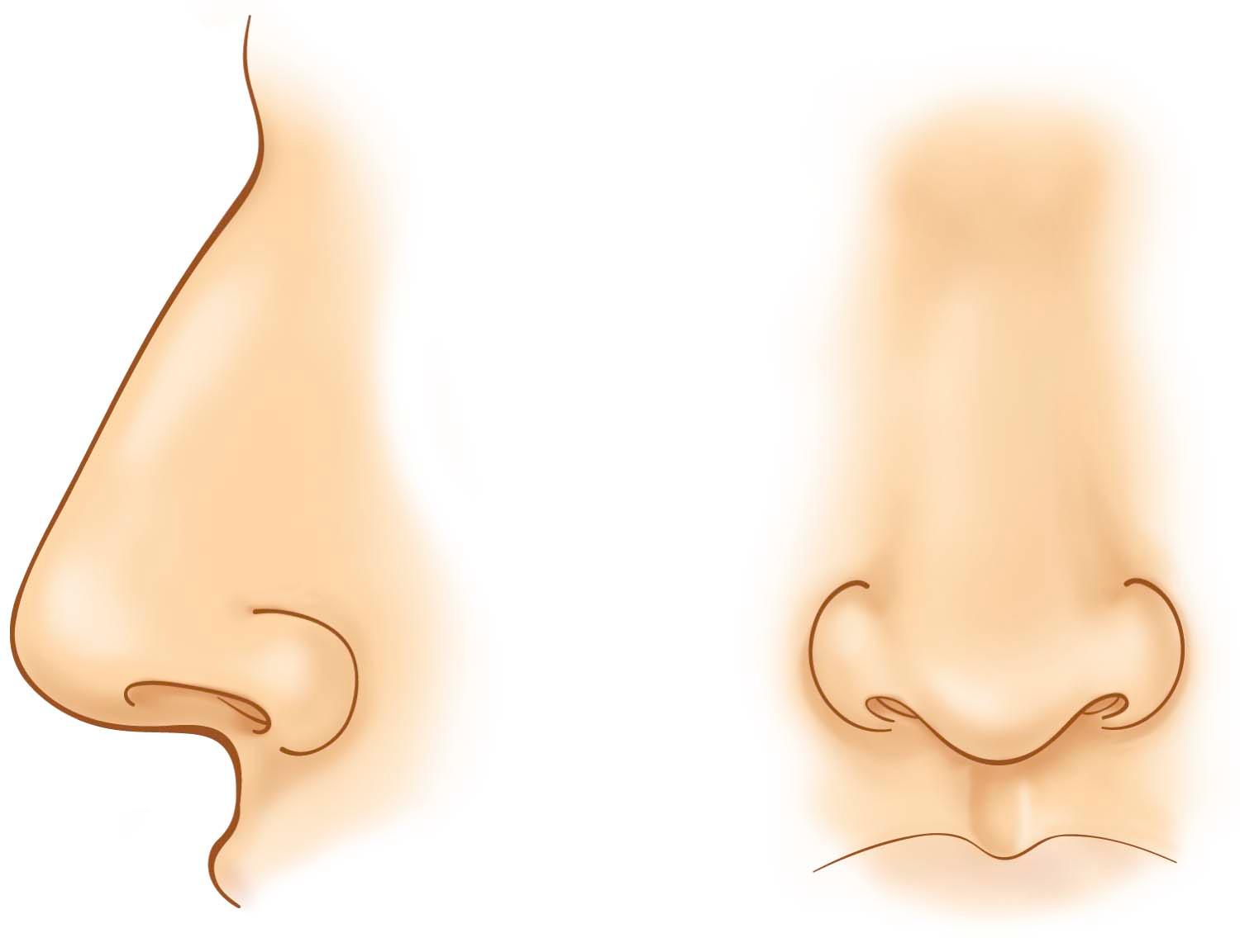 Figure 31-1, Unique features define the ethnic appearance of a Middle Eastern nose.