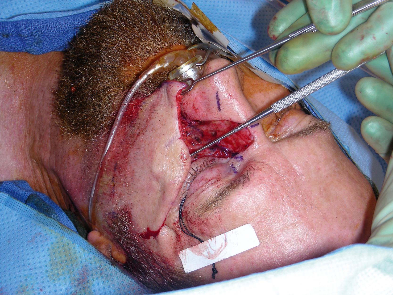 Fig. 3.4, Intraoperative view showing the amount of rotation and advancement from the medial cheek advancement flap for coverage of this large skin defect.