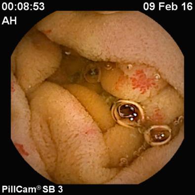 FIG 17.2, Angioectasia seen at video capsule endoscopy (VCE).