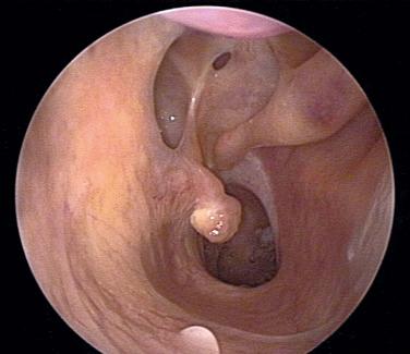 Fig. 2.1, Endoscopic view of the right nasal cavity after near total inferior turbinectomy. Patients with such extensive turbinate resection are at risk for atrophic rhinitis.