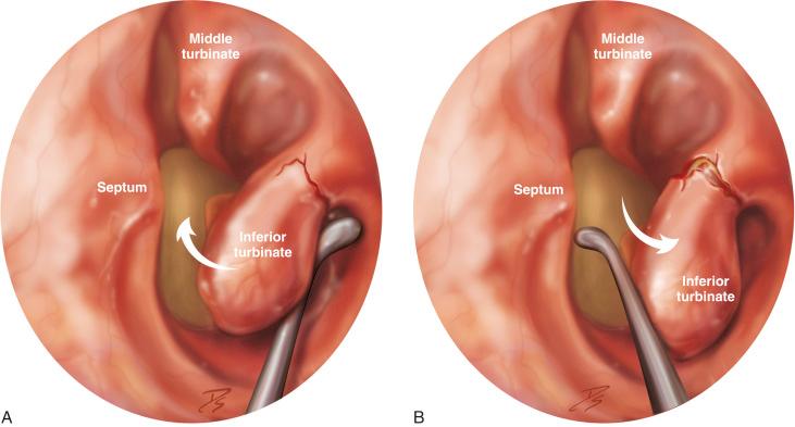 Fig. 2.2, Artist’s depiction of inferior turbinate outfracture in endoscopic view. (A) The inferior turbinate is medialized so that the fracture point of the bone is at the attachment of the lateral nasal wall. (B) The inferior turbinate is lateralized with a Freer or Boies-Goldman elevator to create a larger inferior airway.