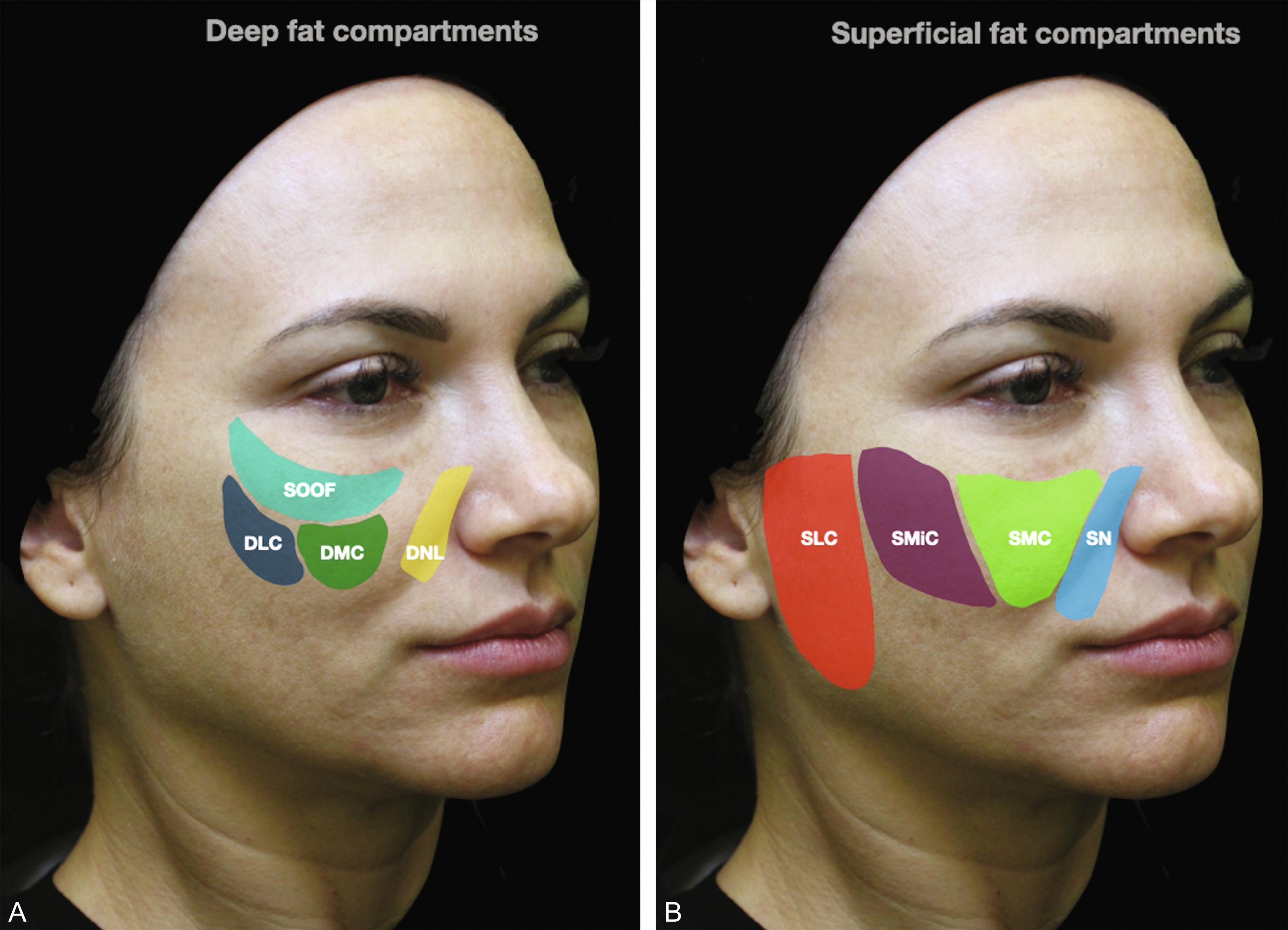 Fig. 21.1, (A) The deep fat compartments are deep nasolabial (DNL) , medial and lateral suborbicularis oculi fat (SOOF) , and deep medial and deep lateral cheek fat portions ( DMC and DLC ). (B) The superficial fat compartments are the superficial nasolabial (SN) , superficial medial cheek (SMC) , superficial middle cheek (SMiC) , and superficial lateral cheek (SLC) .