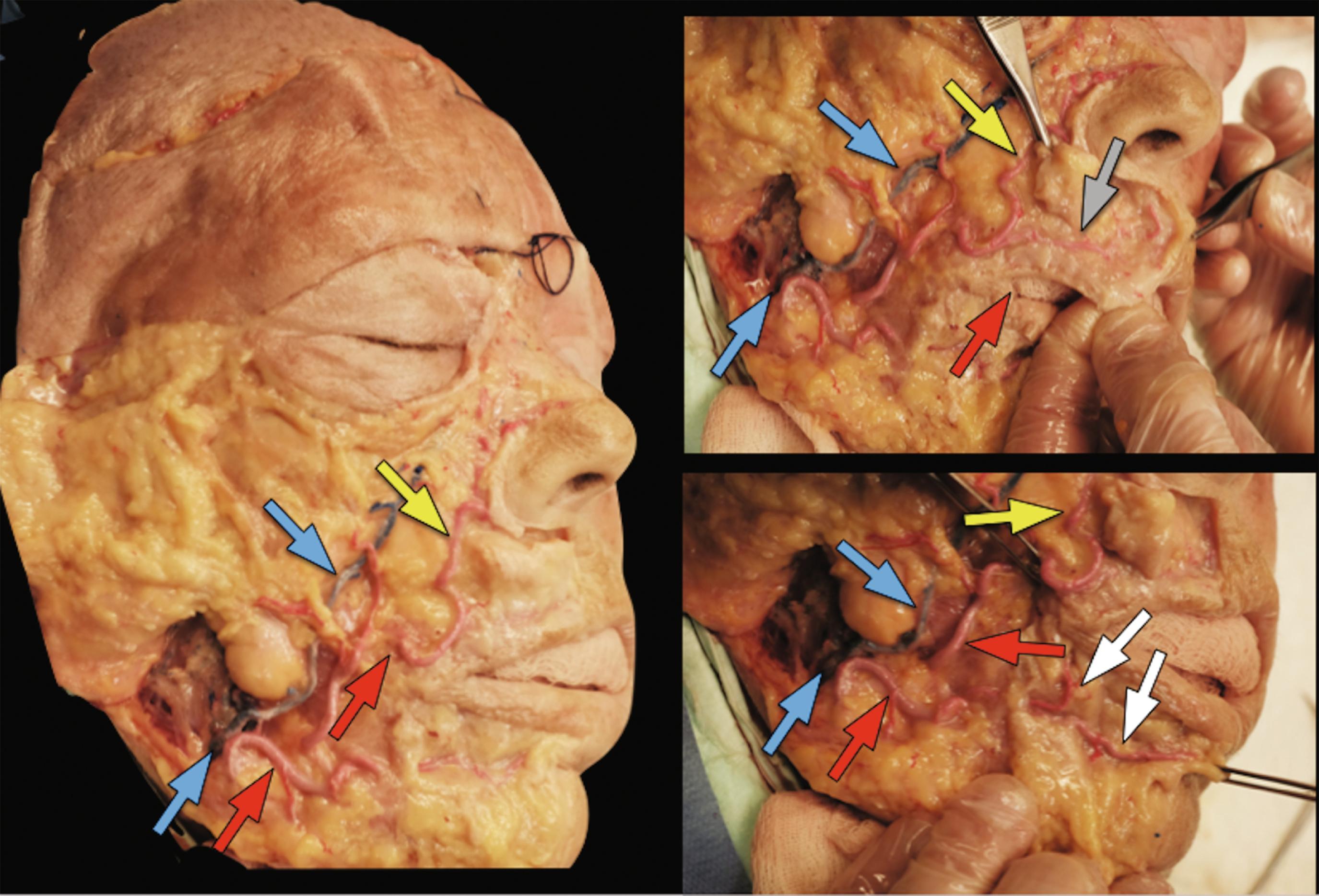 Fig. 21.2, Anatomic specimen illustrating the main vessels of the midface: facial artery (red arrows) , facial vein (blue arrows) , angular artery (yellow arrows) , superior labial artery (gray arrow) , and inferior labial artery (white arrows).