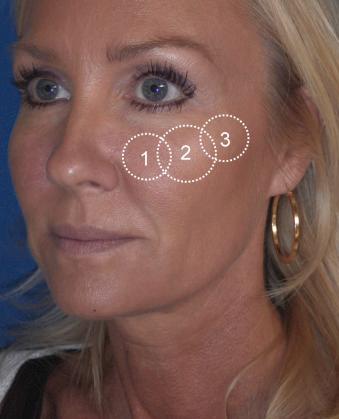 Figure 21.4, The main areas of volume loss and subsequent augmentation are the infraorbital region (1) , the malar/submalar region (2) , and the zygomatic region (3) .