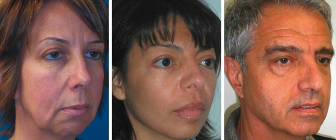 Figure 21.5, This image shows the infraorbital, malar, and zygomatic regions that influence aging deflation and rejuvenative inflation. The patient on the left has typical submalar deflation and is an excellent candidate for a submalar implant. The middle picture shows a patient with adequate submalar volume but requiring malar augmentation and could be treated with a malar shell–type implant. The right image shows a patient with both submalar and malar deficiency, who would be an excellent candidate for a combined submalar implant.