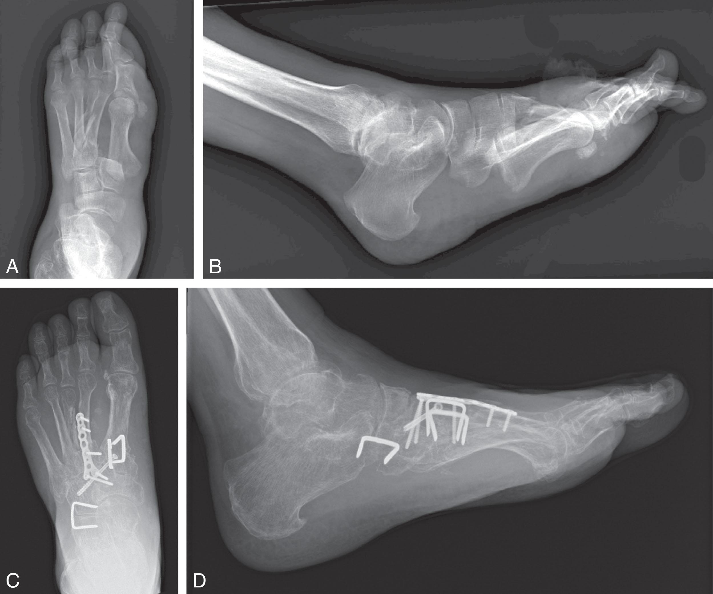 Fig. 26-1, A, AP and ( B ) lateral of left foot with midfoot injury sustained via forklift crush injury. C, AP and ( D ) lateral of primary midfoot arthrodesis for midfoot fracture dislocation.