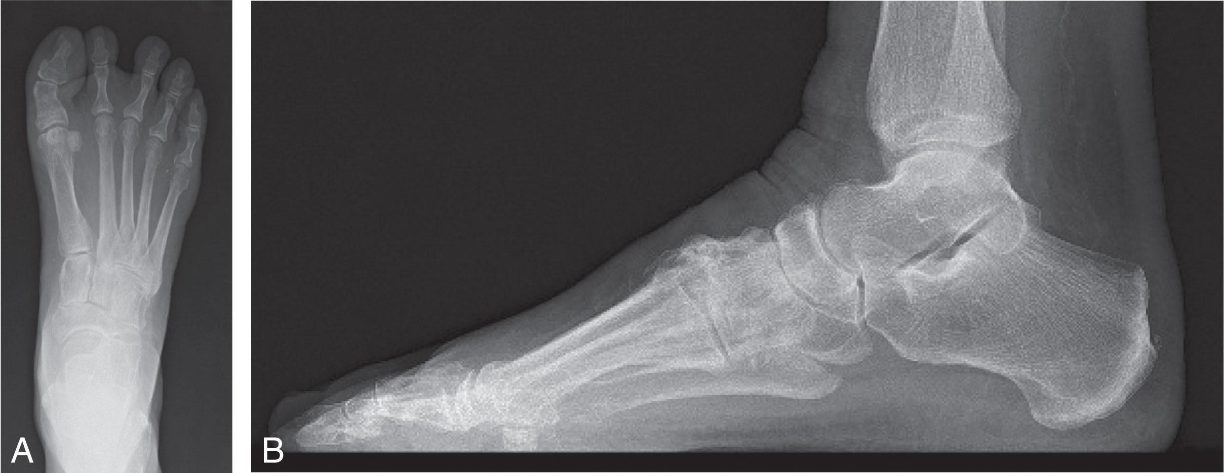 Fig. 26-2, A, AP and ( B ) lateral images of the right foot demonstrates osteoarthritic joint space narrowing most pronounced at the second tarsometatarsal joint.