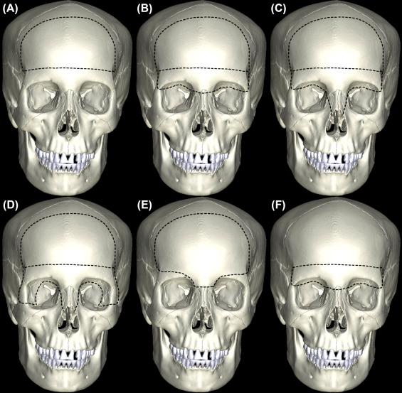 Figure 11.1, Schematic demonstrating the variations of the transbasal approach. (A) The classic transbasal approach is essentially a bifrontal craniotomy without removal of the supraorbital bar. The surgical view of the clivus is limited by bony overhang of the supraorbital bar in the midline. (B) The extended transbasal approach (Level 1) comprises a bifrontal craniotomy and removal of the supraorbital bar. Osteotomies are made across the nasofrontal suture medially, and across the frontozygomatic suture laterally. The surgical view of the anterior skull base, clivus, and nasal sinuses is greatly improved by providing a more basal approach to the anterior skull base. (C) The Level 2 extended transbasal approach includes further removal of the nasal bone to improve access to the ethmoid sinus and medial orbital walls. The surgical view is similar to that of a transfacial approach where facial incisions are avoided. Detachment of the medial canthal ligaments is required for exposure. (D) The Level 3 extended transbasal approach is similar to the Level 2 approach with additional removal of the lateral orbital walls. Detachment of both medial and lateral canthal ligaments is required. (E) The modified one-piece extended transbasal approach provides a low basal approach to the skull base by incorporating the anterior wall of the frontal sinus without removing the entire supraorbital bar. The surgical view is equivalent to that of Level 1 extended transbasal approach to the clival region. (F) The subcranial approach involves removal of the supraorbital bar alone without a traditional bifrontal craniotomy.