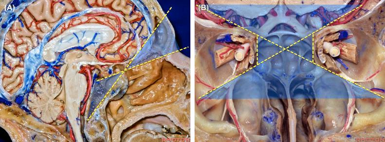 Figure 11.3, Schematic diagram demonstrating the zones of exposure with a transbasal and a Level 1 extended transbasal approach. (A) In the sagittal plane, the view and trajectory to the clivus via a standard transbasal approach is limited by the nasal bone inferiorly and by the frontal lobe superiorly. Removing the supraorbital bar in the Level 1 extended transbasal approach, increases the view and trajectory to the clivus. (B) In the coronal plane, the Level 1 extended transbasal approach provides exposure of the orbits, anterior skull base, and paranasal sinuses. The most superolateral maxillary sinus remains a blind spot with this approach.