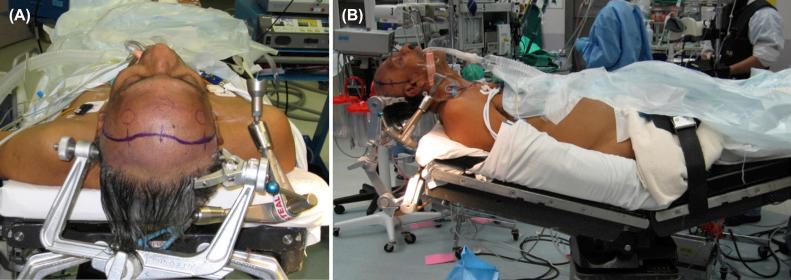 Figure 11.4, Intraoperative photographs illustrating the position and skin incision for the transbasal approach. (A) Bicoronal incision. (B) The patient is positioned supine with the head of the bed elevated about 30 degrees and the neck slightly extended.