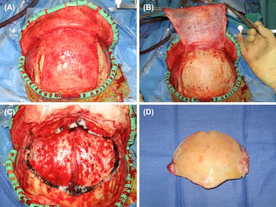 Figure 11.5, Intraoperative photographs of the modified one-piece extended transbasal approach. (A) The scalp is elevated in two layers: a galeocutaneous flap and a vascularized pedicled pericranial flap. (B) The pericranial flap is undermined posterior to the incision to maximize its length. (C) A bifrontal bone flap incorporating the anterior wall of the frontal sinus is elevated without removing of the supraorbital bar. The exposure is flush with the contour of the anterior skull base. (D) Modified one-piece extended transbasal bifrontal bone flap that incorporates the anterior wall of the frontal sinus.