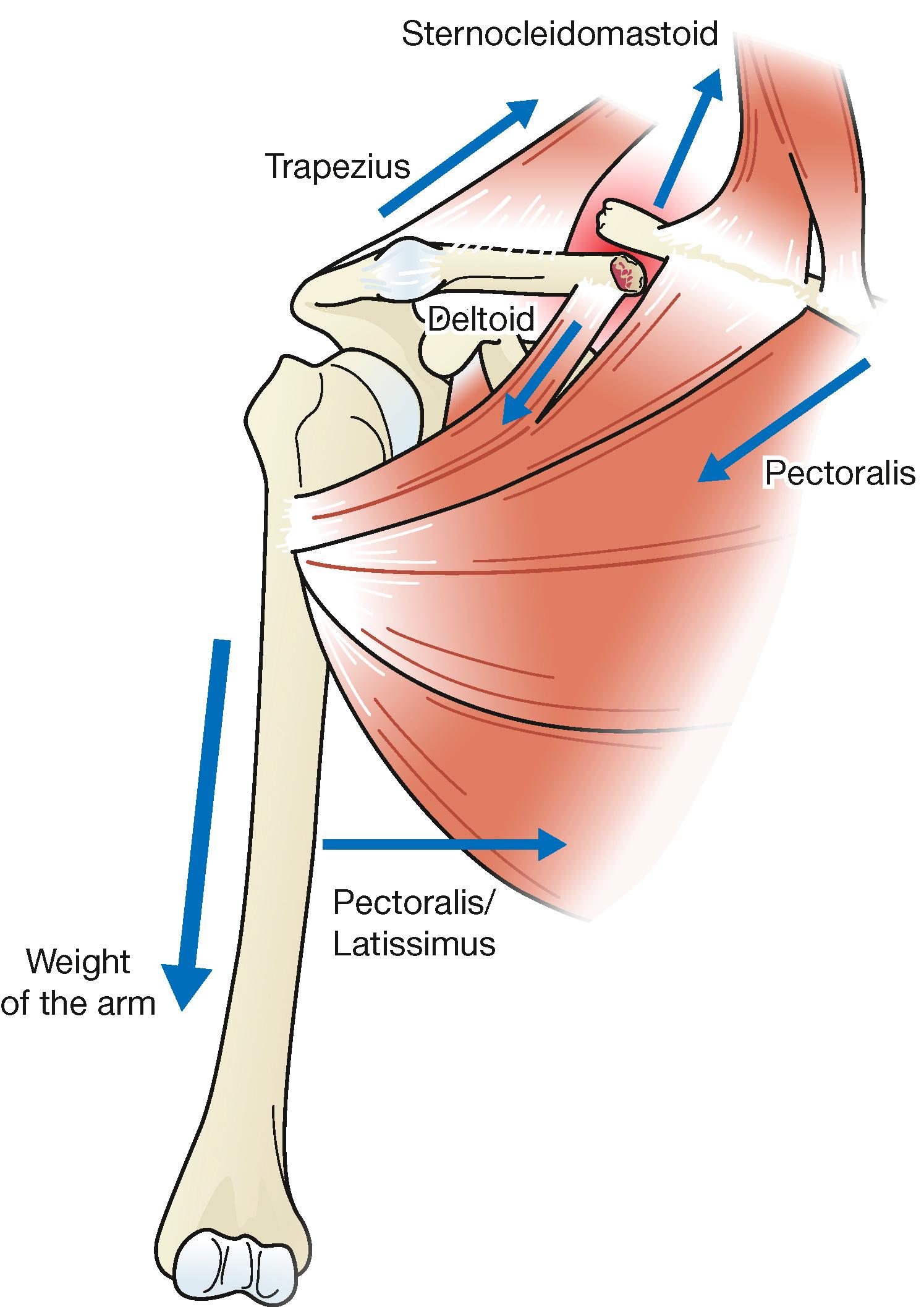 Fig. 6.1, Muscle attachments leading to classic fracture deformity.