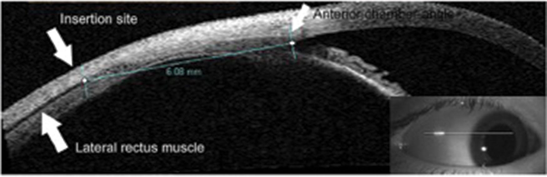 Fig. 4.7, Anterior segment optical coherence tomography of an extraocular muscle for primary surgery. The lateral rectus muscle of the right eye is imaged. The distance from the insertion of the lateral rectus to the anterior chamber angle as measured with the caliper is 6.08 mm.