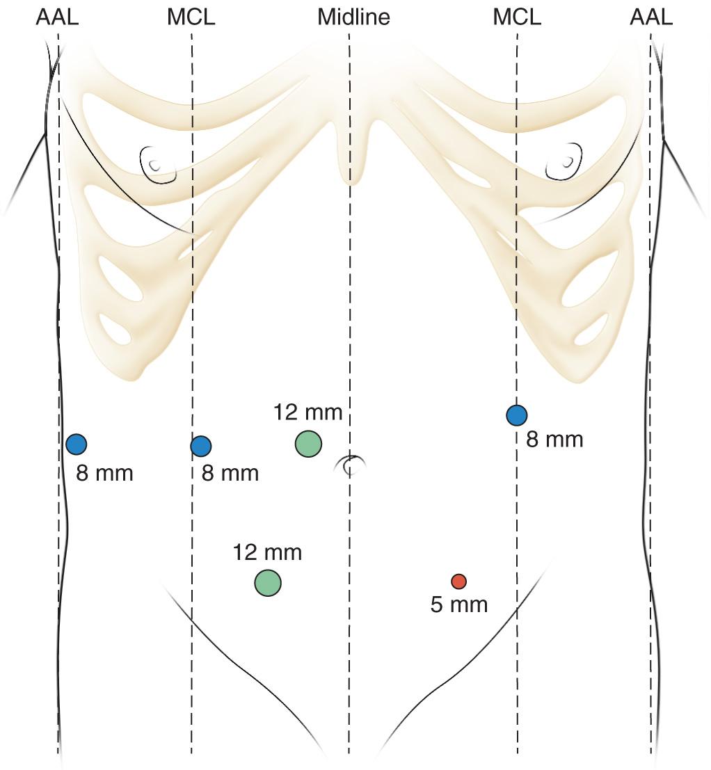 FIGURE 101.1, Robotic cyst-gastrostomy—port placement. Periumbilical 12-mm camera port; three upper 8-mm robotic arms; right lower quadrant 12-mm laparoscopic port; left lower quadrant 5-mm laparoscopic assistant port. AAL, Anterior axillary line; MCL, midclavicular line.