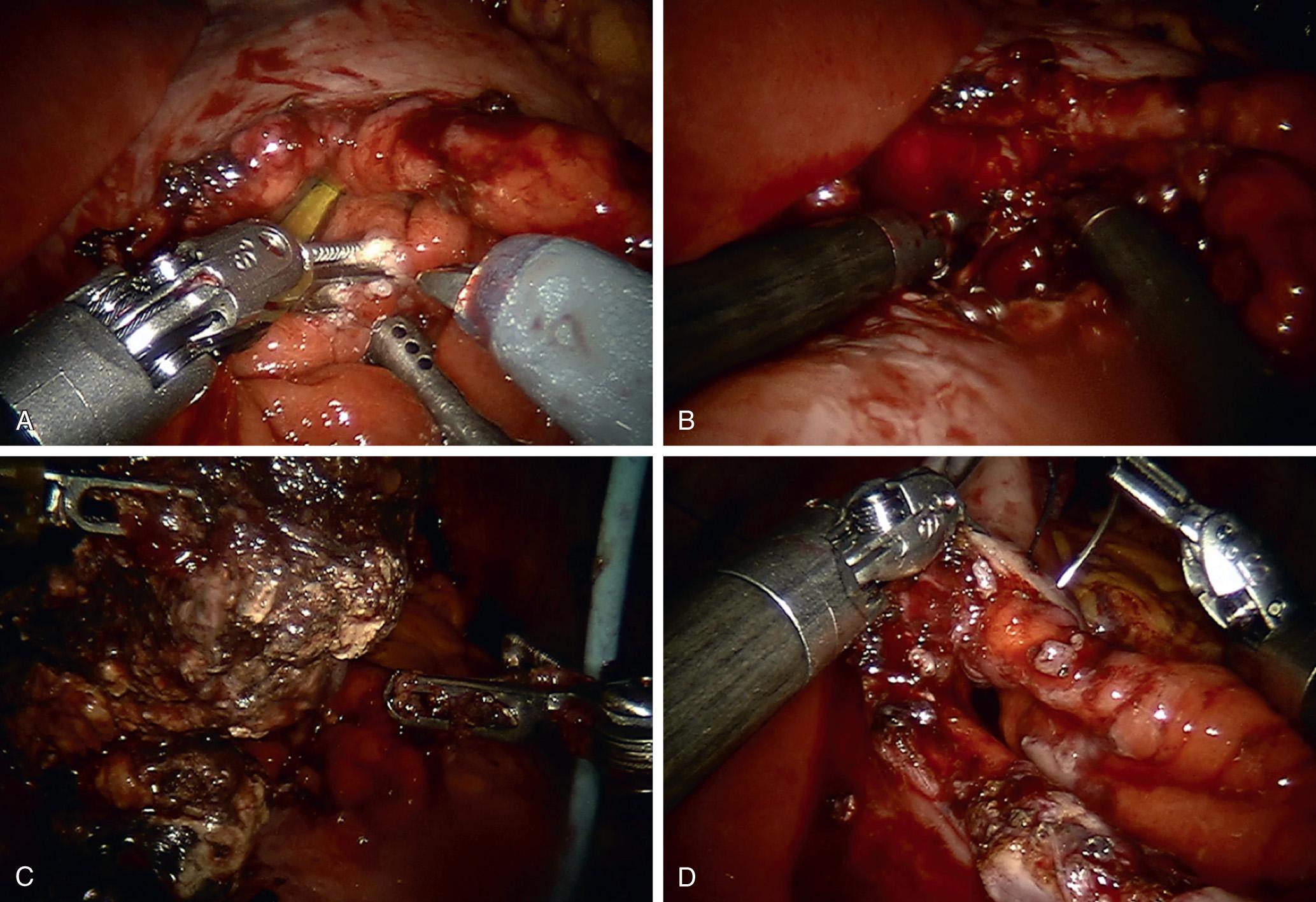 FIGURE 101.2, Robotic cyst-gastrostomy—technique. (A) Anterior gastrostomy. (B) Posterior gastrostomy and entrance to walled-off pancreatic necrosis. (C) En bloc débridement of walled-off pancreatic necrosis. (D) Closure of anterior cyst gastrostomy with running suture.