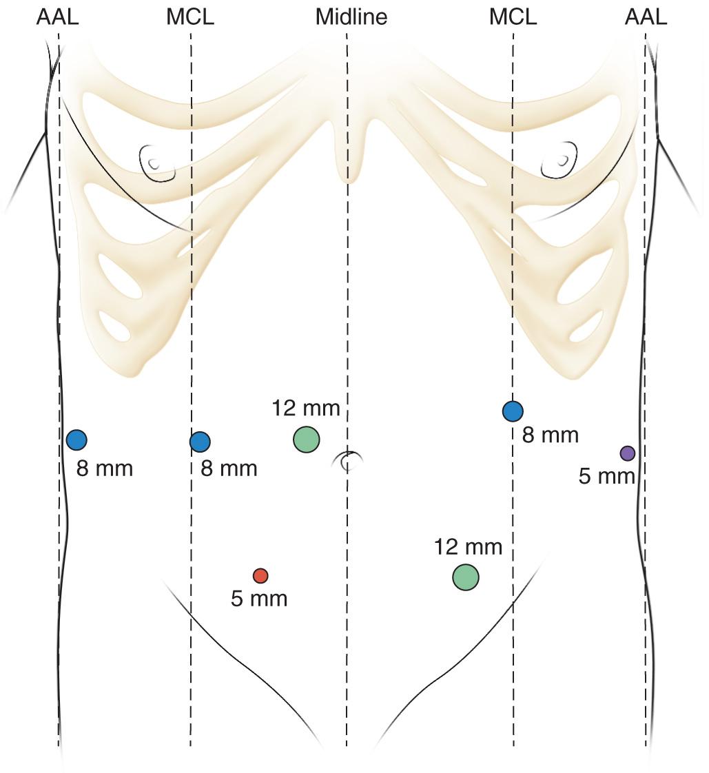 FIGURE 101.3, Robotic total pancreatectomy with auto islet transplantation—port placement. Periumbilical 12-mm camera port; three upper 8-mm robotic arms; left 5-mm self-retaining retractor (purple) ; left lower quadrant 12-mm laparoscopic port and specimen extraction site; right lower quadrant 5-mm laparoscopic port (red) . AAL, Anterior axillary line; MCL, midclavicular line.
