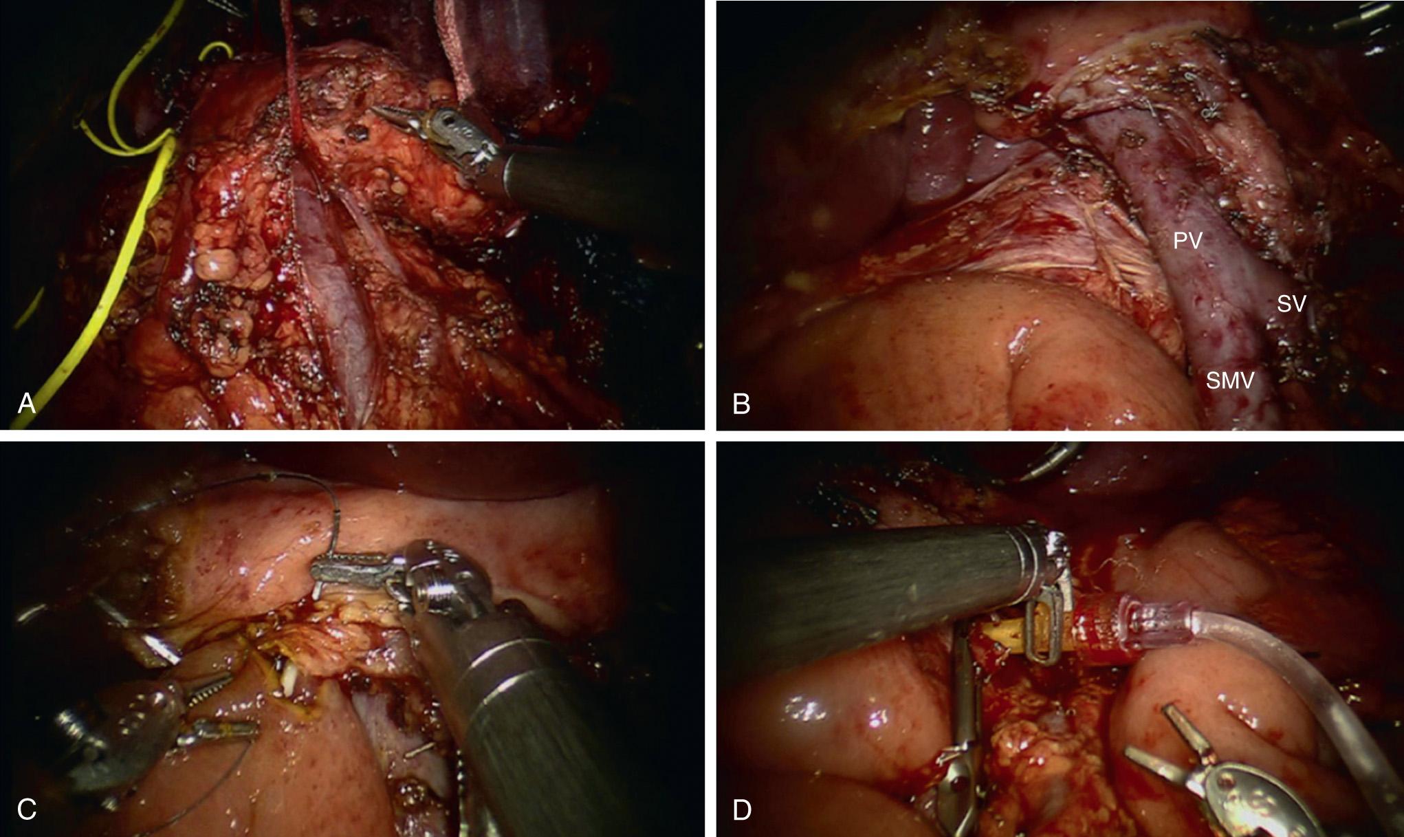 FIGURE 101.4, Robotic total pancreatectomy with auto islet transplantation—technique. (A) Pancreatic neck is freed from the superior mesenteric vein (SMV) , splenic vein (SV) , and portal vein (PV) . (B) Resection of entire pancreas from the retroperitoenum. (C) Creation of hepaticojejunostomy over a stent. (D) Angiocatheter introduced through the SV stump for islet cell infusion.