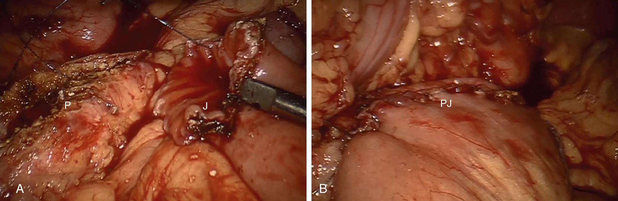 FIGURE 101.5, Robotic lateral pancreaticojejunostomy (Puestow procedure). (A) Pancreatic duct (P) and jejunostomy (J) in preparation for anastomosis. (B) Completed pancreaticojejunostomy anastomosis (PJ) .