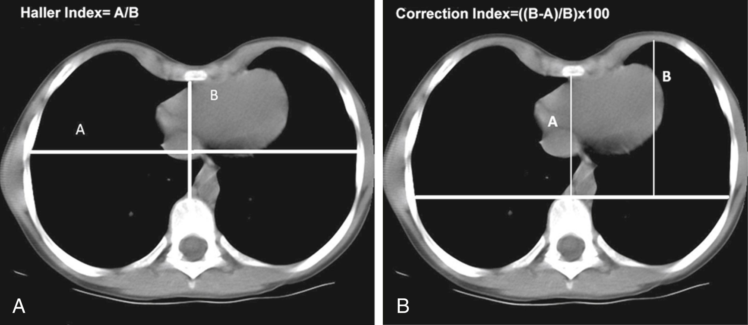 Fig. 40-2, A, The Haller Index is measured by dividing the transverse diameter of the chest wall by the distance between the posterior aspect of the sternum and the anterior portion of the vertebral body at the deepest point. B, The Correction Index measures the depression of the sternum relative to the anterior chest.