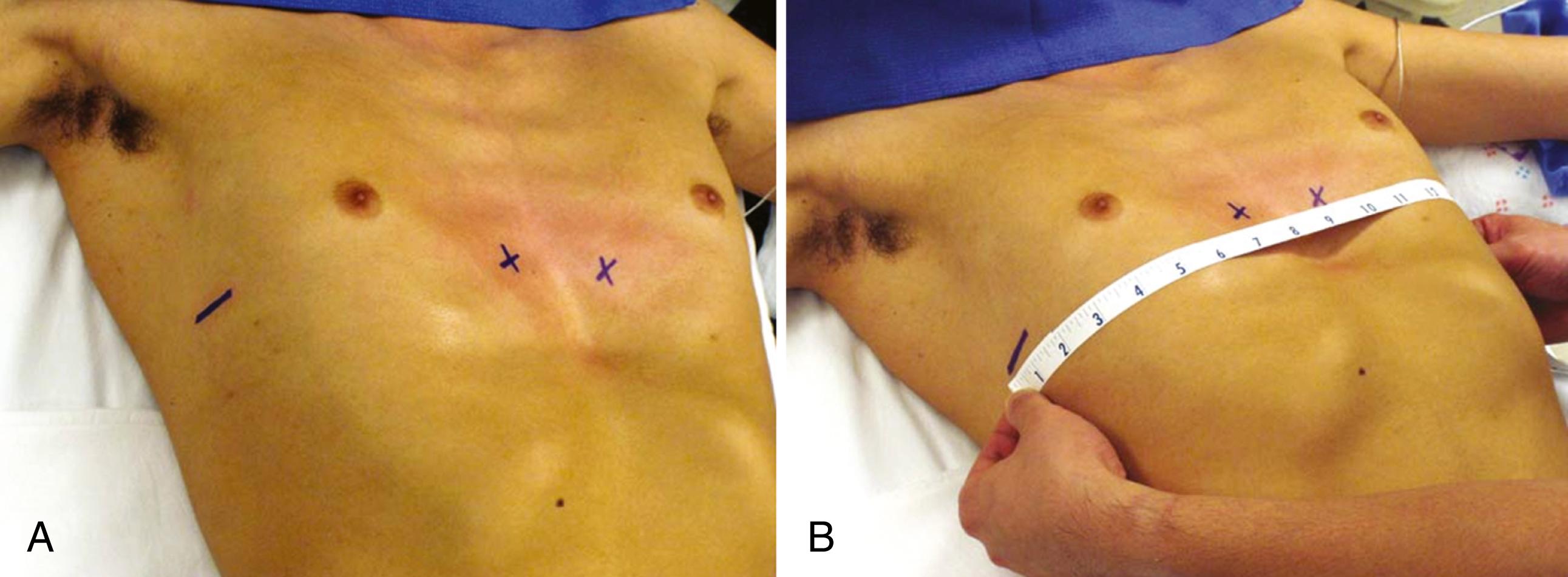Fig. 40-3, A, The patient is positioned supine on the operating table with the arms abducted. The deepest point of the depression at the lower end of the sternum is noted. The bar entry and exit sites into and out of the mediastinum are marked with an X, and the lateral thoracic incisions are marked with a horizontal line. B, The chest is measured from the right midaxillary line to the left midaxillary line. The bar should be this measured length minus 1 inch.