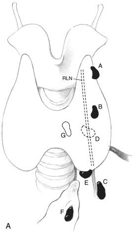 Fig. 57.1, A, The anterior-posterior view of the cervical region showing the relationship of the parathyroid glands to the recurrent laryngeal nerve (RLN). The letters depict the gland locations. A, B, and C glands are superior glands and are generally located in the superior triangle formed by the RLN medially with the triangle base superior. E and F glands are inferior glands and are generally located in the inferior triangle with the RLN laterally and the triangle base inferior. D glands are those closest to the RLN and cannot be easily deciphered as superior or inferior without intraoperative assessment of the pedicle in relation to the RLN. The G gland is intrathyroidal. B, Lateral view of the cervical region shows the oblique angle and anterior-posterior projections of enlarged parathyroid glands. The letters depict the gland locations.