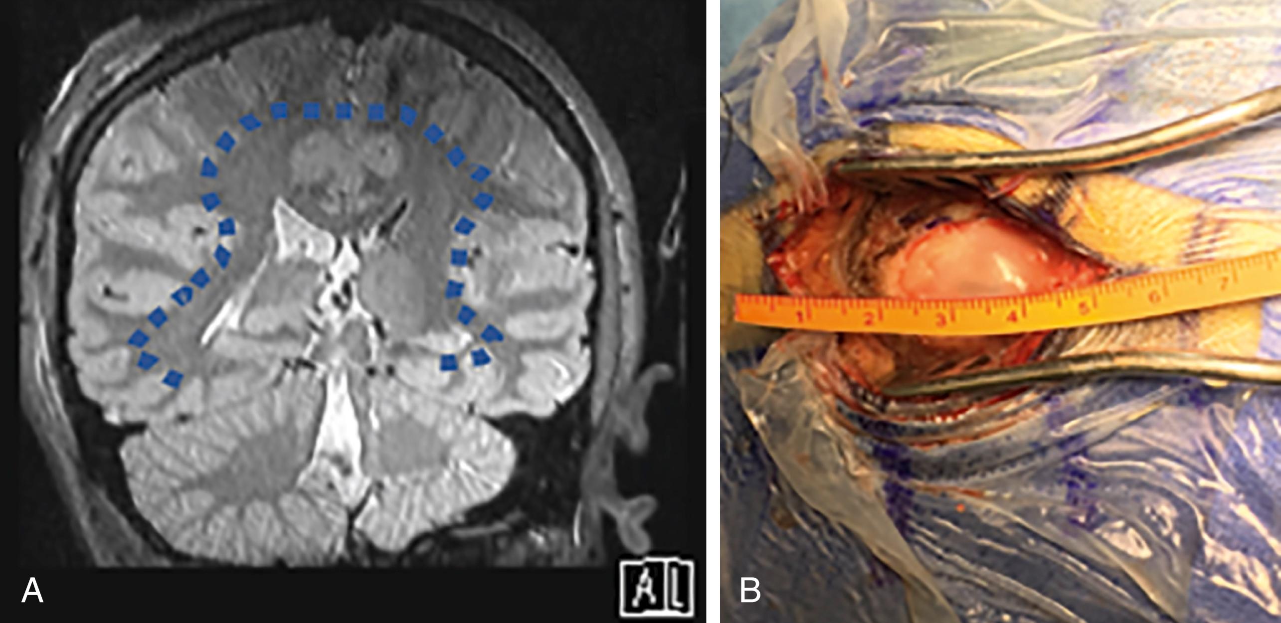 FIGURE 18.1, Indications for the use of tubular retractors. (A) Coronal T2-weighted MRI demonstrating superficial boundary for the use of tubular retractors (blue dotted line) . Lesions should ideally be below the deepest sulcal boundary when using tubular retractors. (B) Example of the typical craniotomy size for minimally invasive deep-seated lesion surgery. Well-positioned craniotomies can be as small as 2.5 cm in diameter.