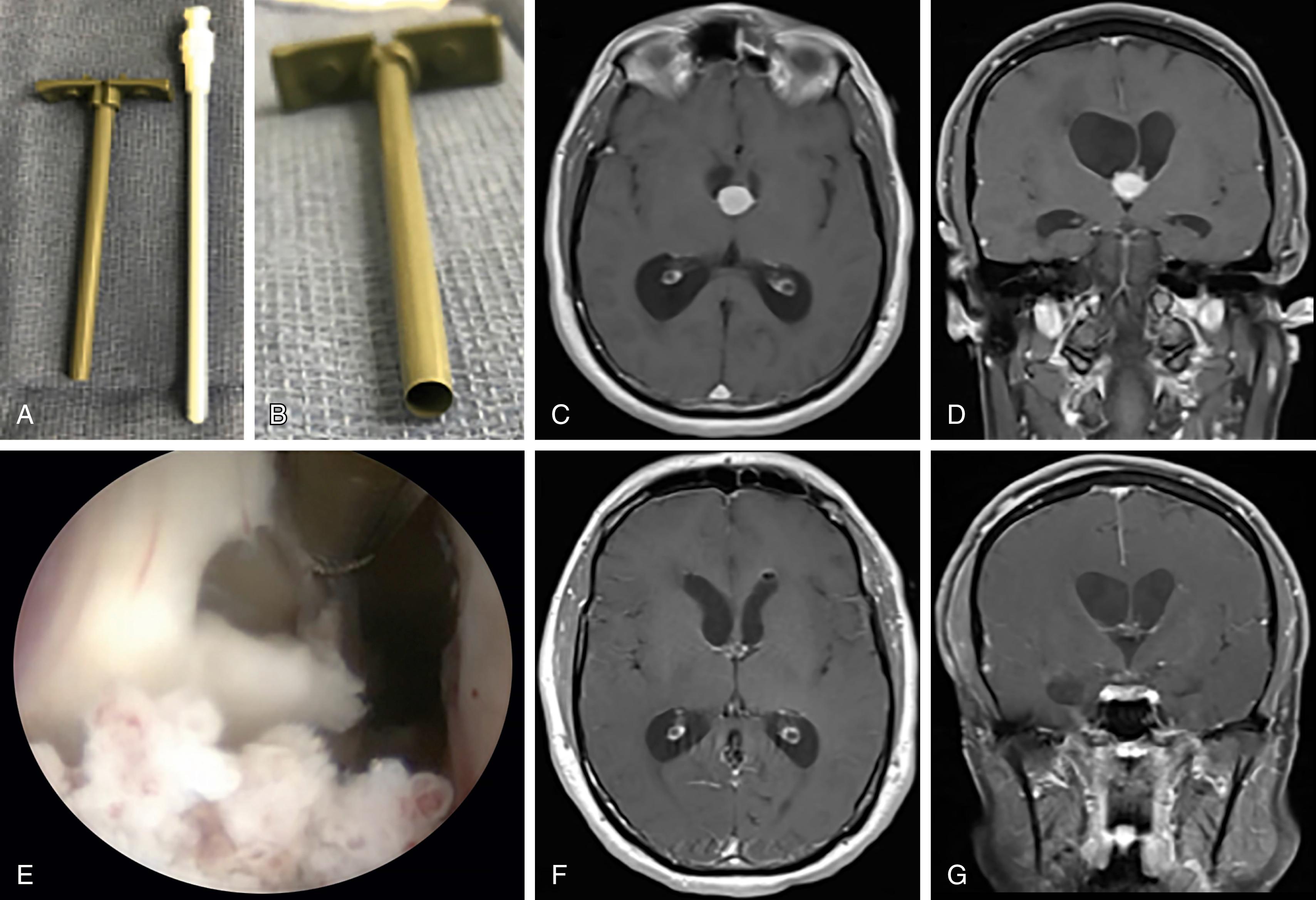 FIGURE 18.2, Example case with peel-away catheter. (A and B) Example of the peel-away catheter with blunt-tipped inner stylet and oblique view of the channel. (C and D) Axial and coronal T1-weighted MRI with contrast of a patient with a deep-seated, intraventricular colloid cyst and obstructive hydrocephalus. (E) The right lateral ventricle was accessed with the peel-away catheter and view is provided by a working channel endoscope and shows internal debulking of the colloid cyst. (F and G) Postoperative axial and coronal T1-weighted MRI with contrast demonstrating gross total resection of the colloid cyst.