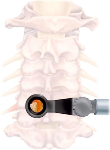 FIGURE 45-4, Minimally invasive tube with the root and disk exposed.