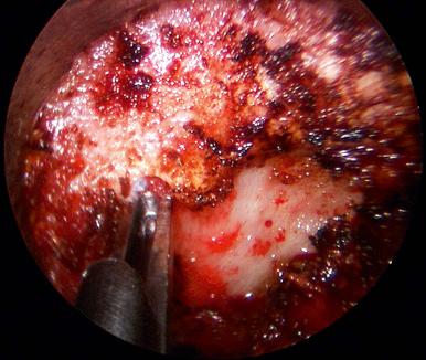 FIGURE 45-7, Intraoperative endoscopic photograph of bony decompression of the lamina-facet junction with a Kerrison-3 punch.