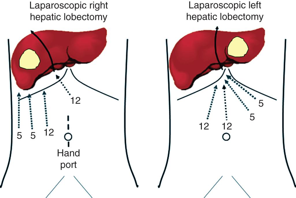 FIGURE 125.1, Trocar placement for laparoscopic right and left hepatic lobectomy.