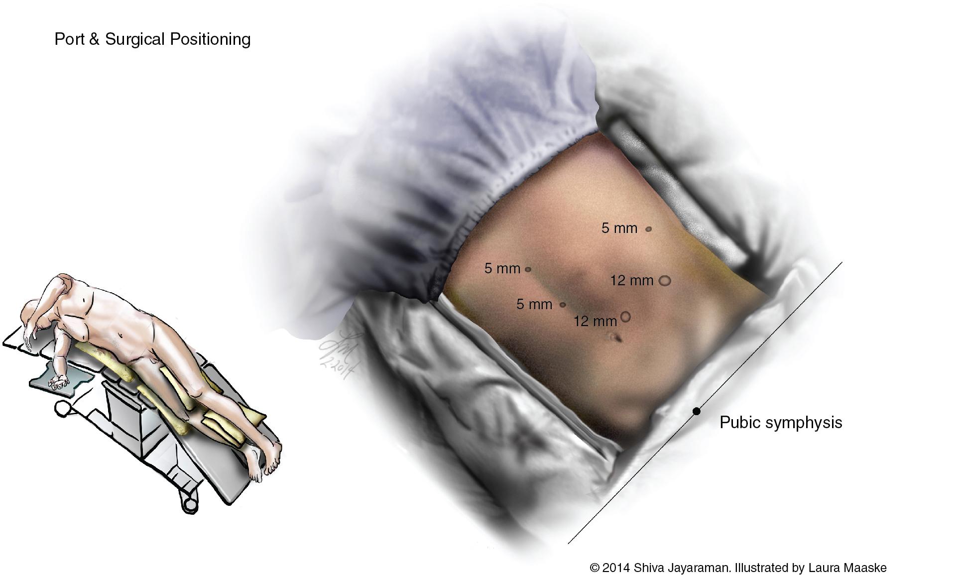 FIGURE 127B.1, Port placement and patient positioning for laparoscopic distal pancreatectomy.