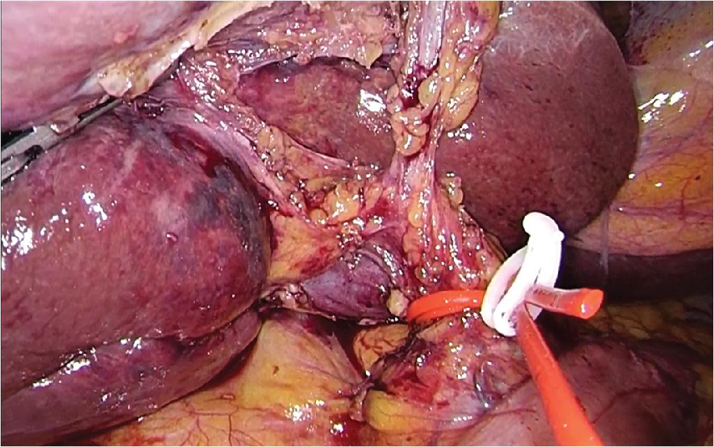 FIGURE 127D.3, Internal Pringle maneuver.