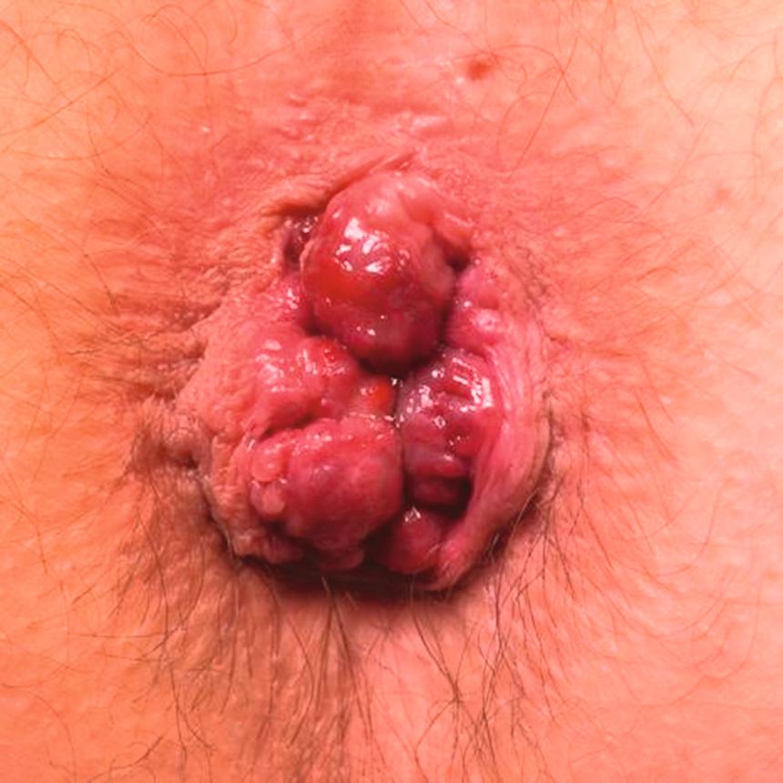 Figure 17.1, Prolapsed haemorrhoids.