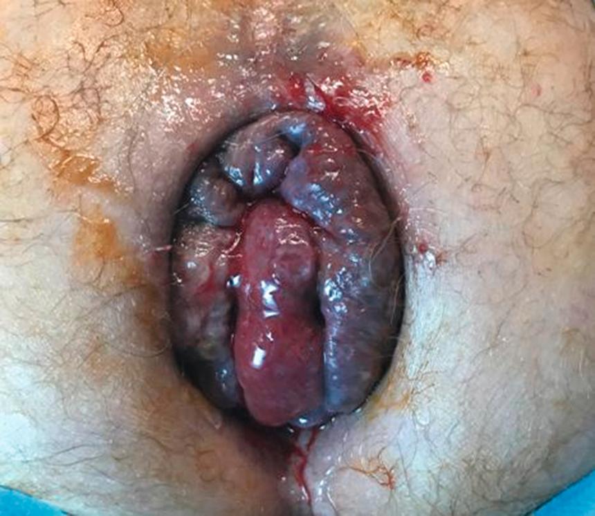 Figure 17.2, Thrombosed prolapsed internal haemorrhoids.