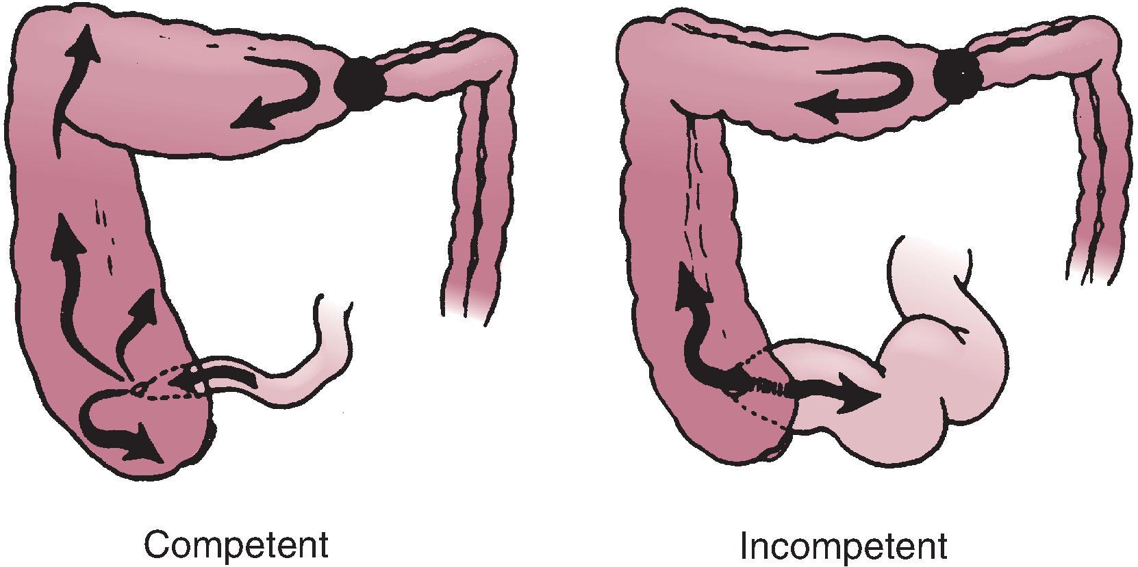 Fig. 46.1, Importance of the ileocecal valve to the radiologic findings in large bowel obstruction. If the ileocecal valve is competent (left) , pronounced cecal dilation can occur. An incompetent valve (right) allows retrograde decompression into the small bowel.