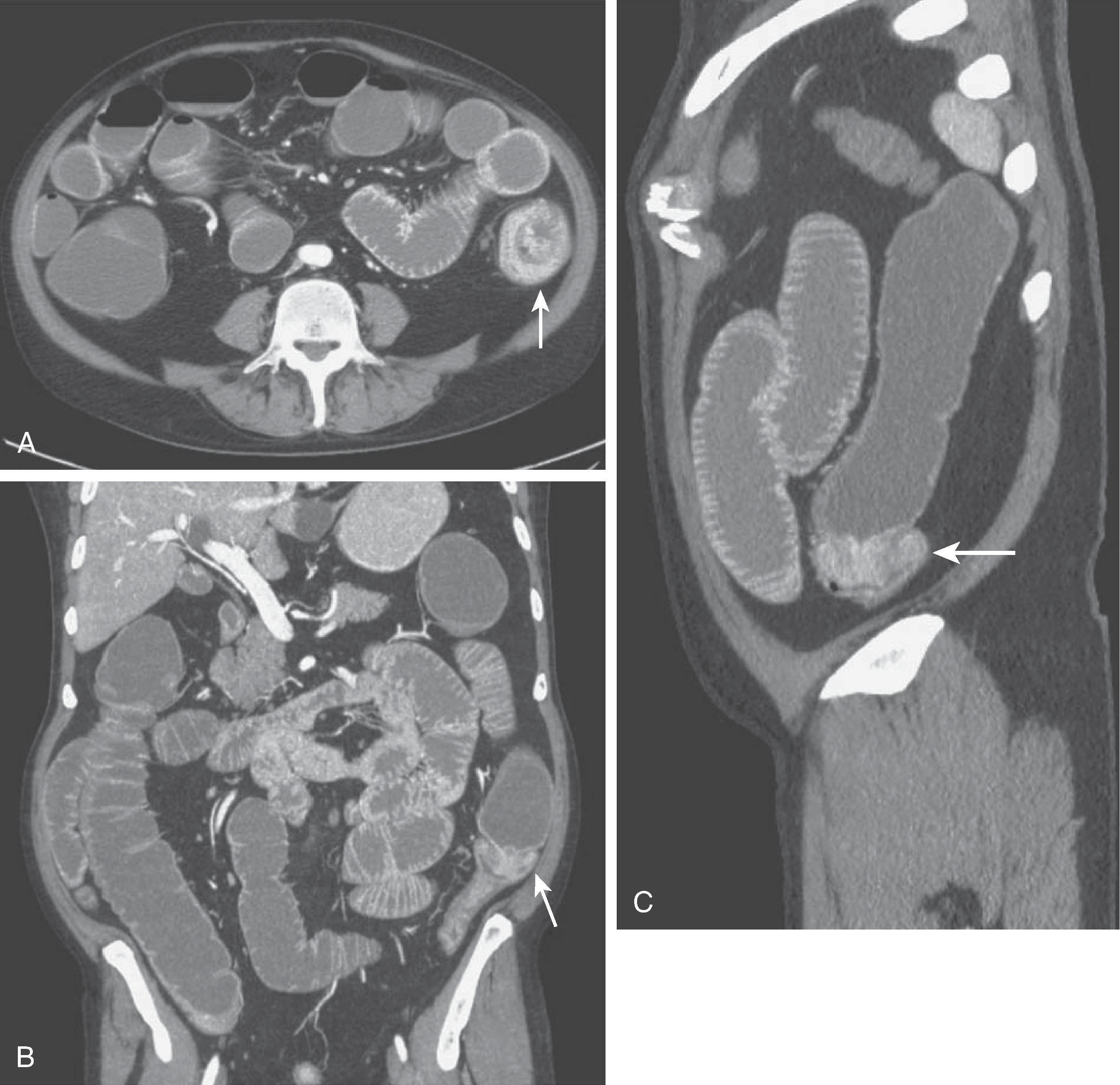 Fig. 46.2, Computed tomography in the evaluation of large bowel obstruction. (A) Axial image shows an enhancing, obstructing mass (arrow) at the junction of the descending colon and sigmoid colon. (B) Coronal reformatted image demonstrates the obstructing cancer (arrow) and dilated, fluid-filled colon, and small bowel. (C) Sagittal depiction of the cancer (arrow) and dilated, fluid-filled colon, and small bowel.