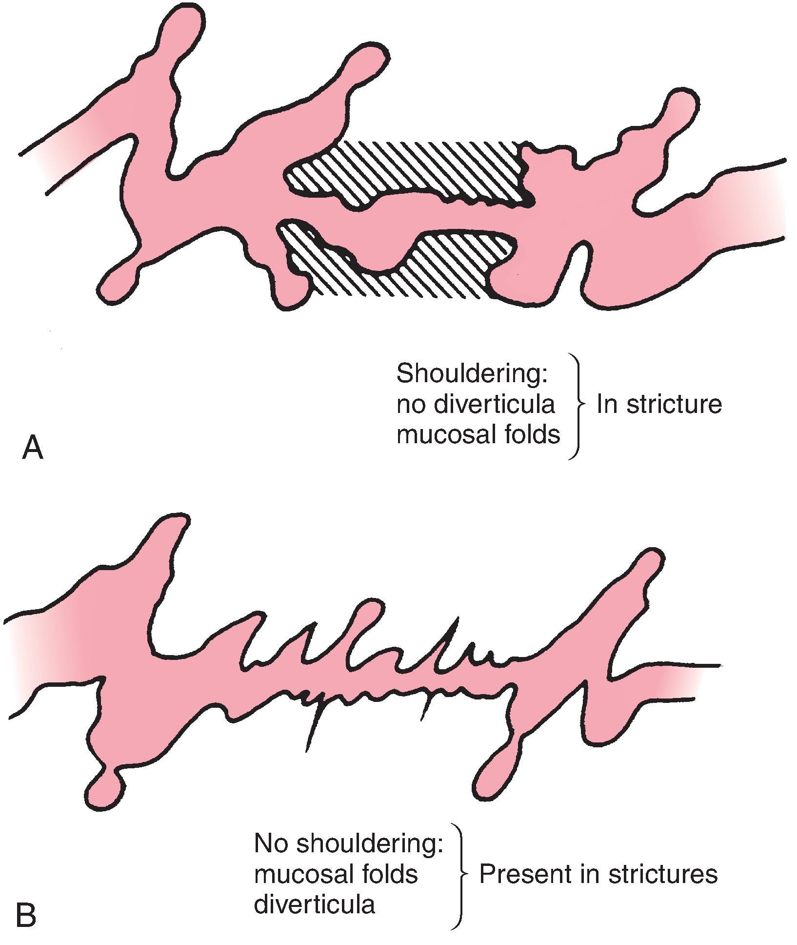 Fig. 46.3, Sigmoid diverticulitis versus carcinoma: barium enema findings. (A) Carcinoma in diverticular disease. (B) Stricturing attributable to diverticular disease.