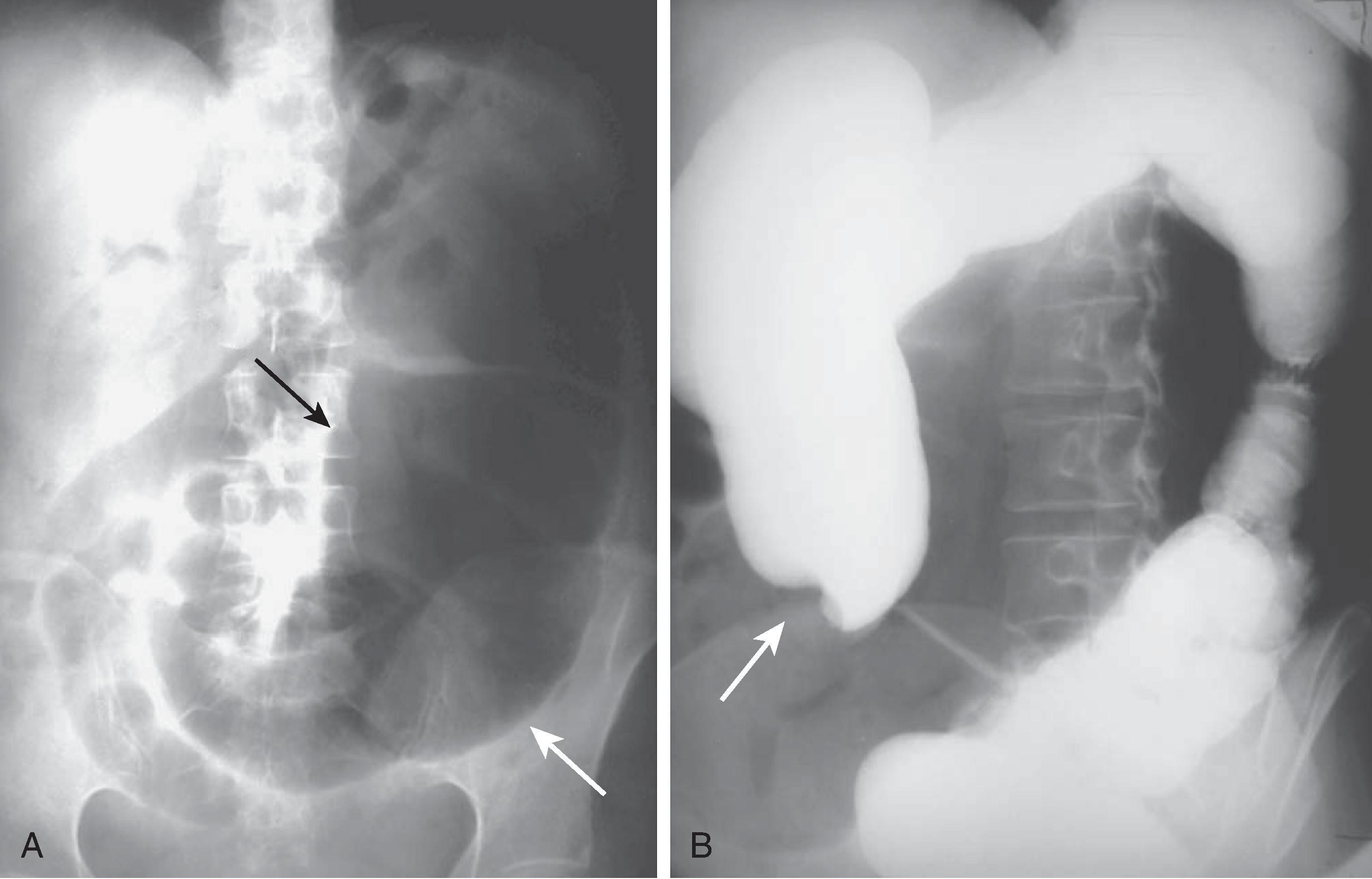 Fig. 46.5, Cecal volvulus: plain radiograph and barium enema features. (A) A distended cecum (arrows) is present in the left lower quadrant. Dilated small bowel is evident proximally. There is a relative paucity of colonic gas distal to the volvulus. (B) Barium enema shows the contrast column ending abruptly (arrow) at the level of the twist.