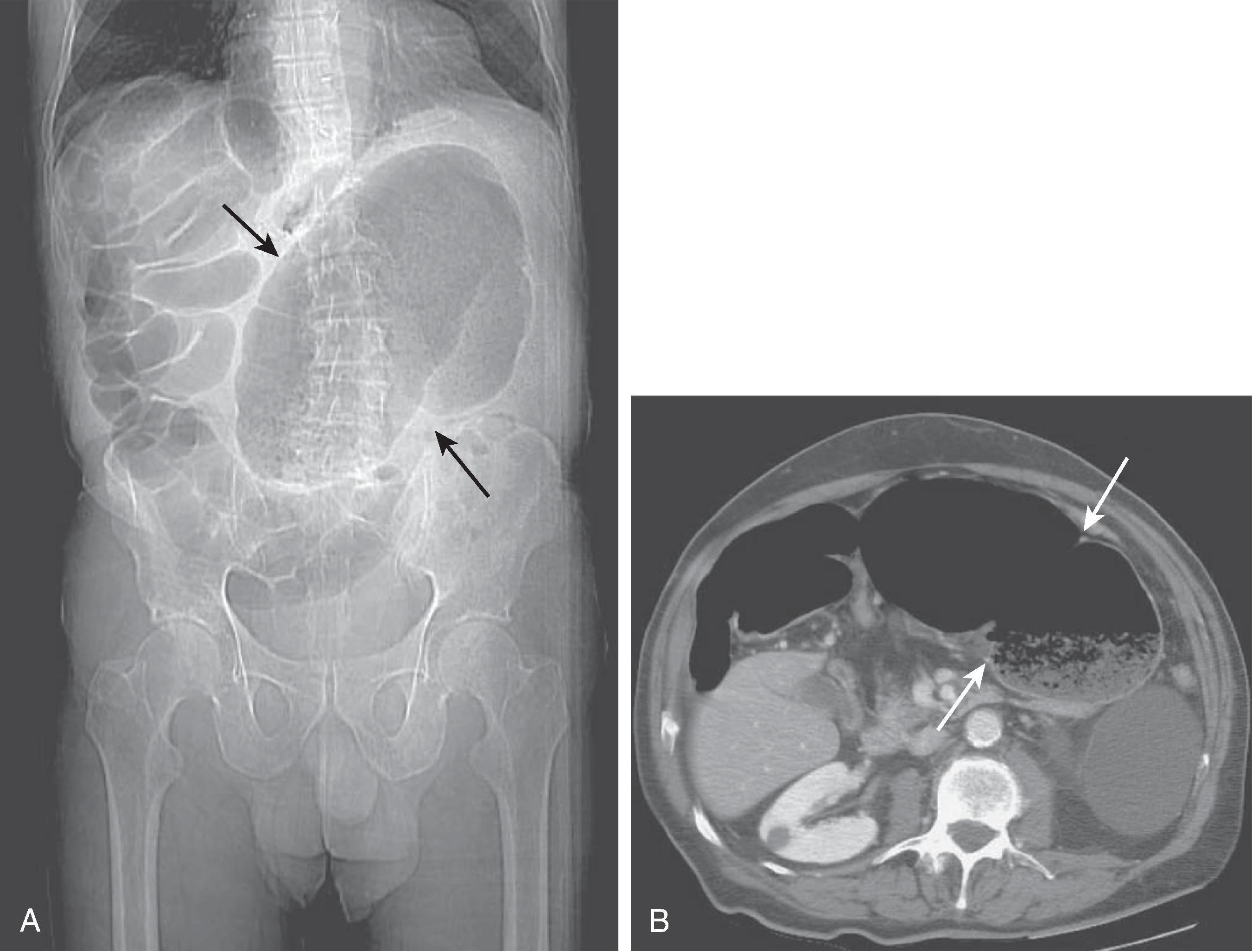 Fig. 46.6, Cecal volvulus: computed tomography (CT) features. (A) Scout image shows that a distended cecum (arrows) is present in the left upper quadrant, with multiple dilated small bowel loops in the right upper quadrant. (B) CT scan demonstrates the malpositioned cecum (arrows) and swirling of the mesentery.