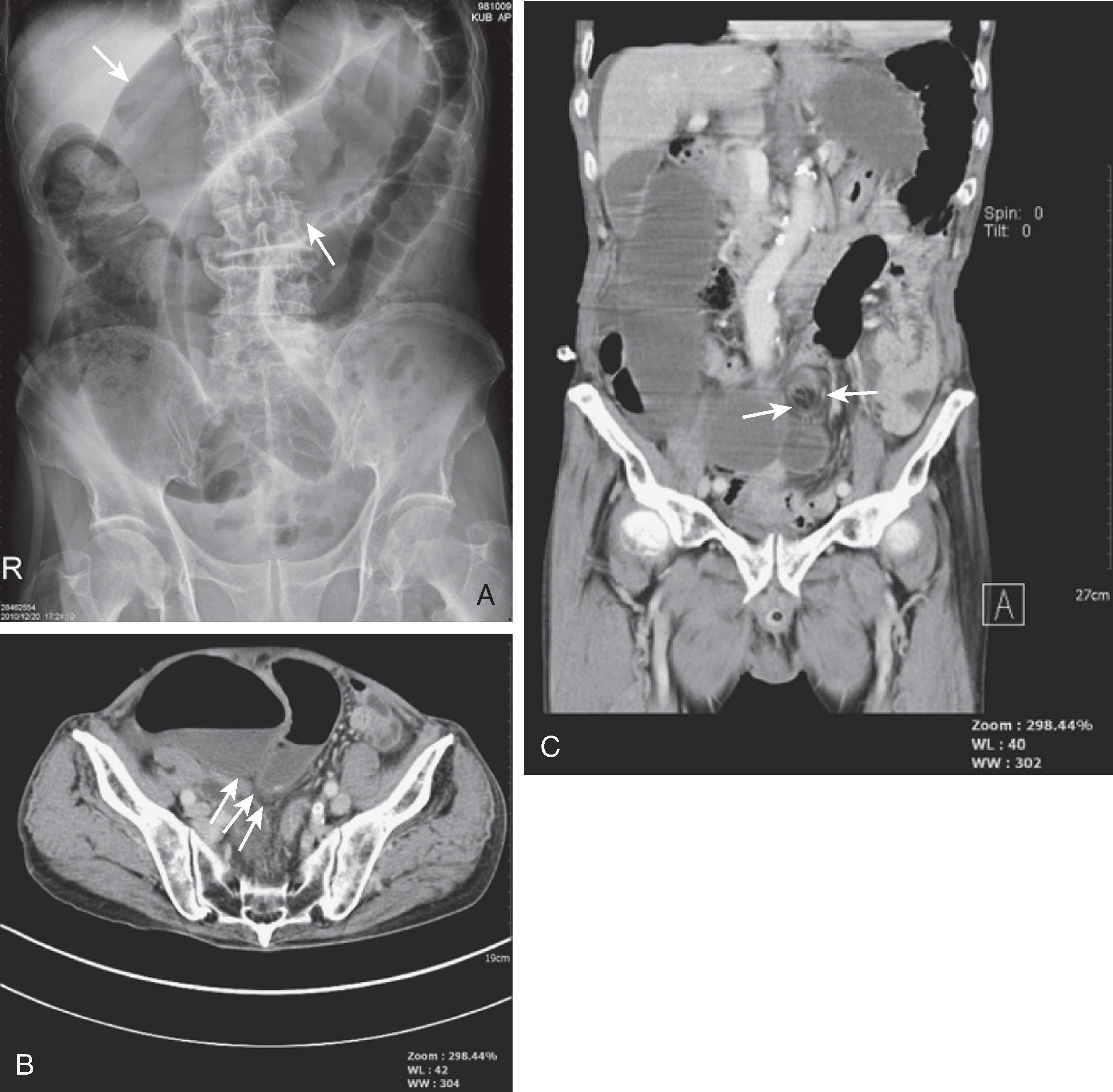 Fig. 46.7, Sigmoid volvulus. (A) Scout image shows a markedly dilated sigmoid colon (arrows) . The apex of the sigmoid colon lies adjacent to the diaphragm, the northern exposure. (B) Computed tomography (CT) scan of the abdomen shows a beak-shaped transition point (arrows) . (C) Coronal reformatted CT image shows the transition zone and swirling of the sigmoid mesocolon (arrows) at the site of the volvulus.