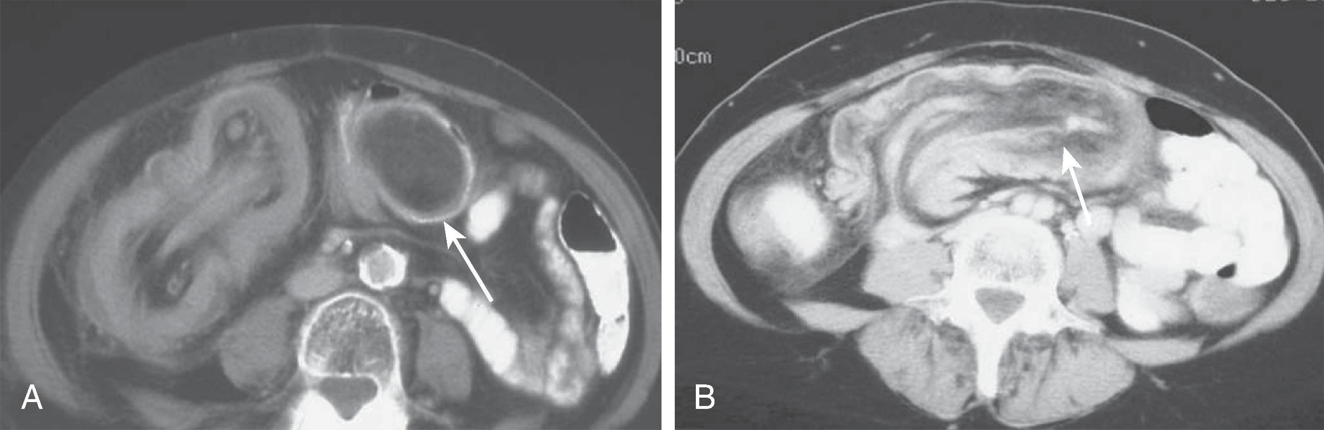 Fig. 46.9, Colonic intussusception: computed tomography findings. (A) The lead point of this colonic intussusception is a lipoma (arrow) . The outer layer represents the intussuscipiens and the inner layer represents the intussusceptum. (B) In a different patient, the cigar-shaped intussusceptum (arrow) is seen within the intussuscipiens.
