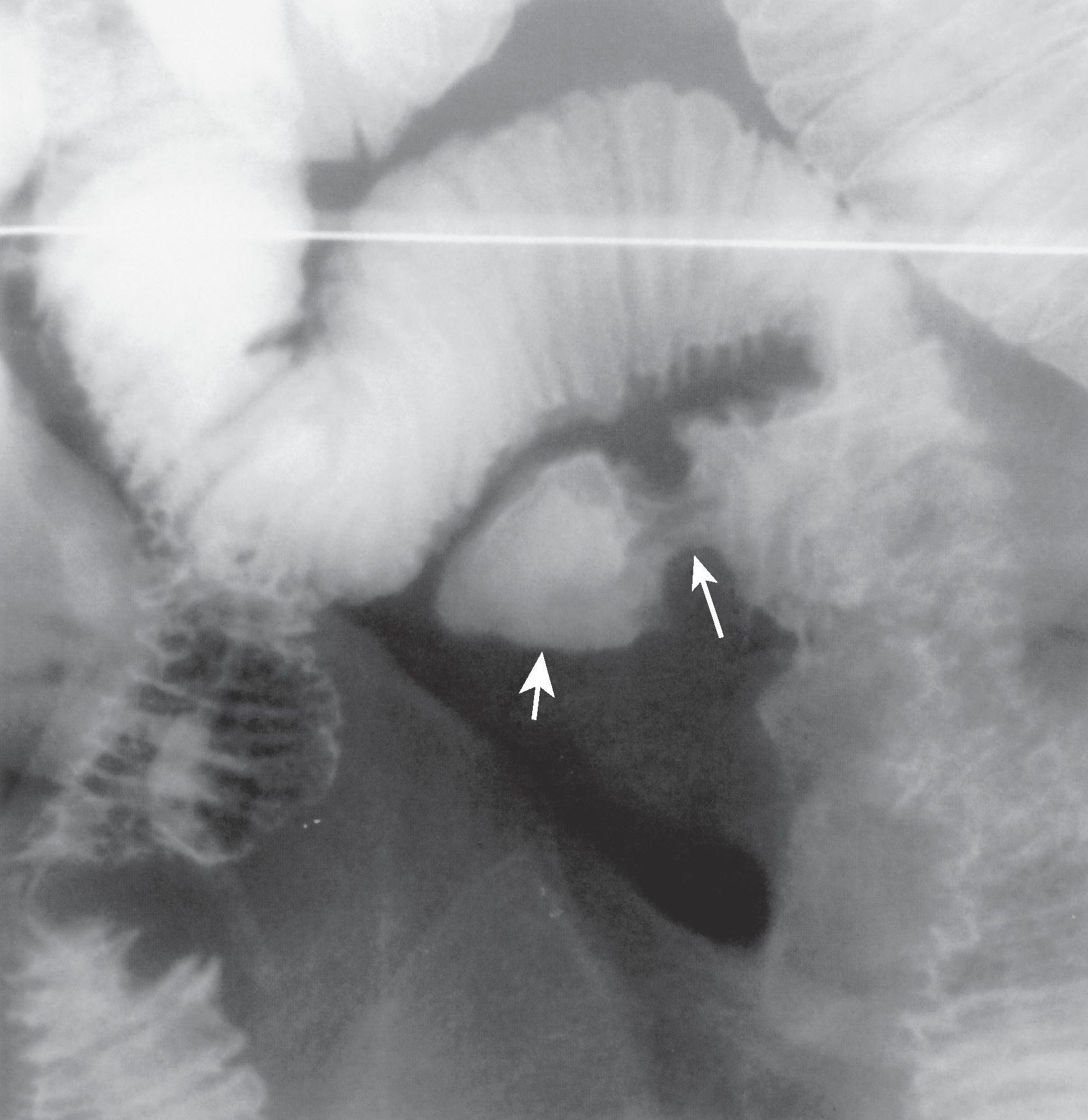 Fig. 35.1, Meckel’s diverticulum.