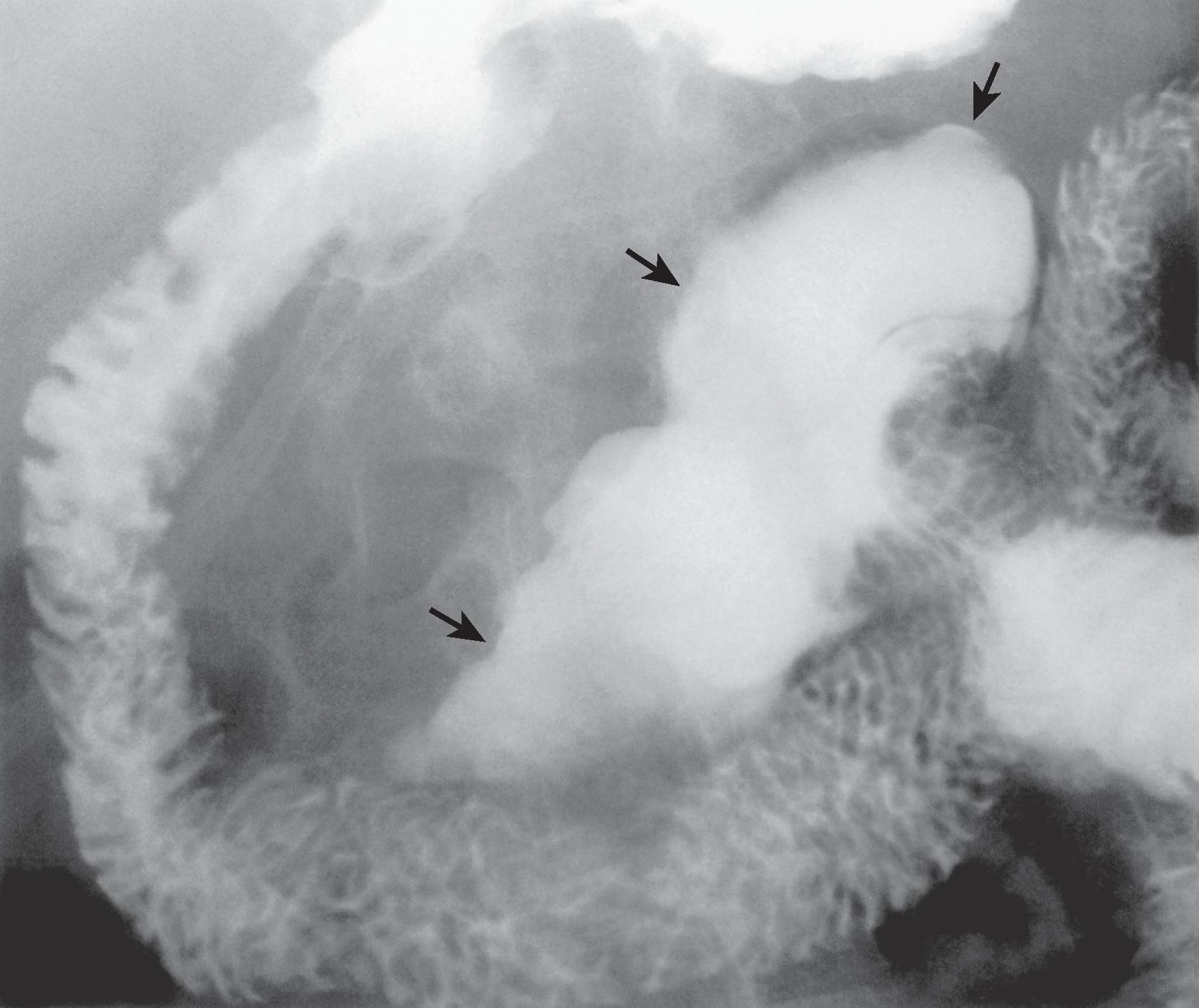 Fig. 35.2, Duodenal duplication cyst.