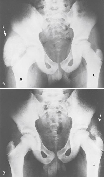 Fig. 31.2, Radiograph of tumoral calcinosis involving soft tissues of both hips (arrows) . Nine months after calcified mass in the right hip ( A ) was removed, a second mass developed in the left hip ( B ).